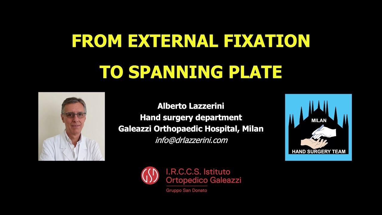 A Lazzerini: From External Fixation to Spanning Plate