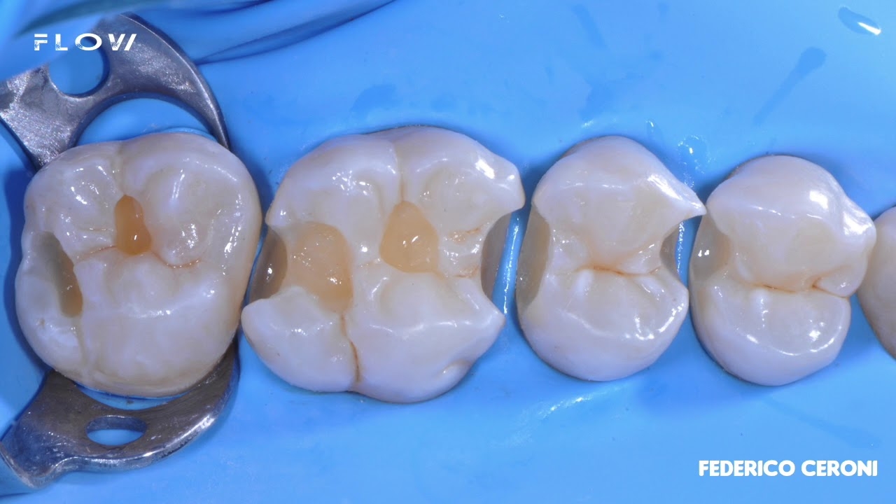 Composite restorations