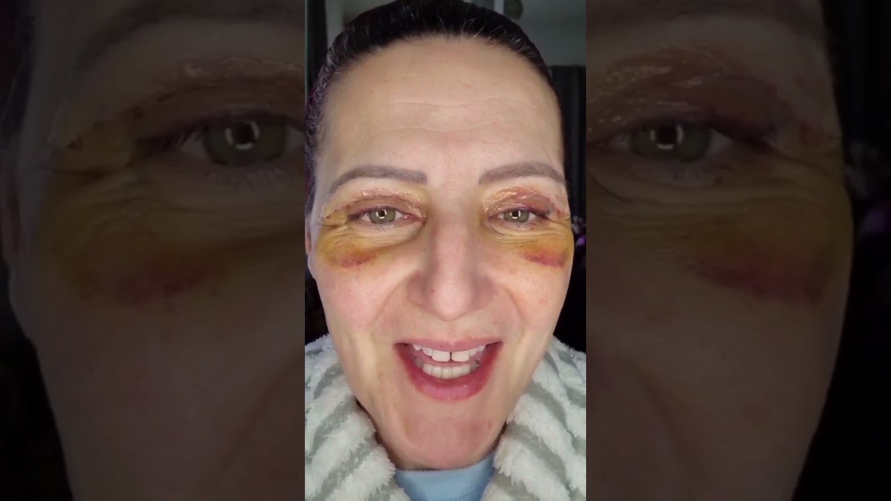 MY BLEPHAROPLASTY!