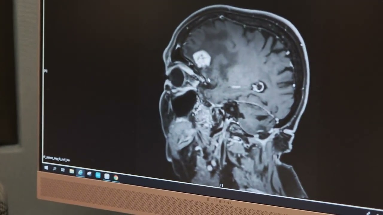 Brain Tumor Treatment Without a Scalpel at Acibadem, Turkey