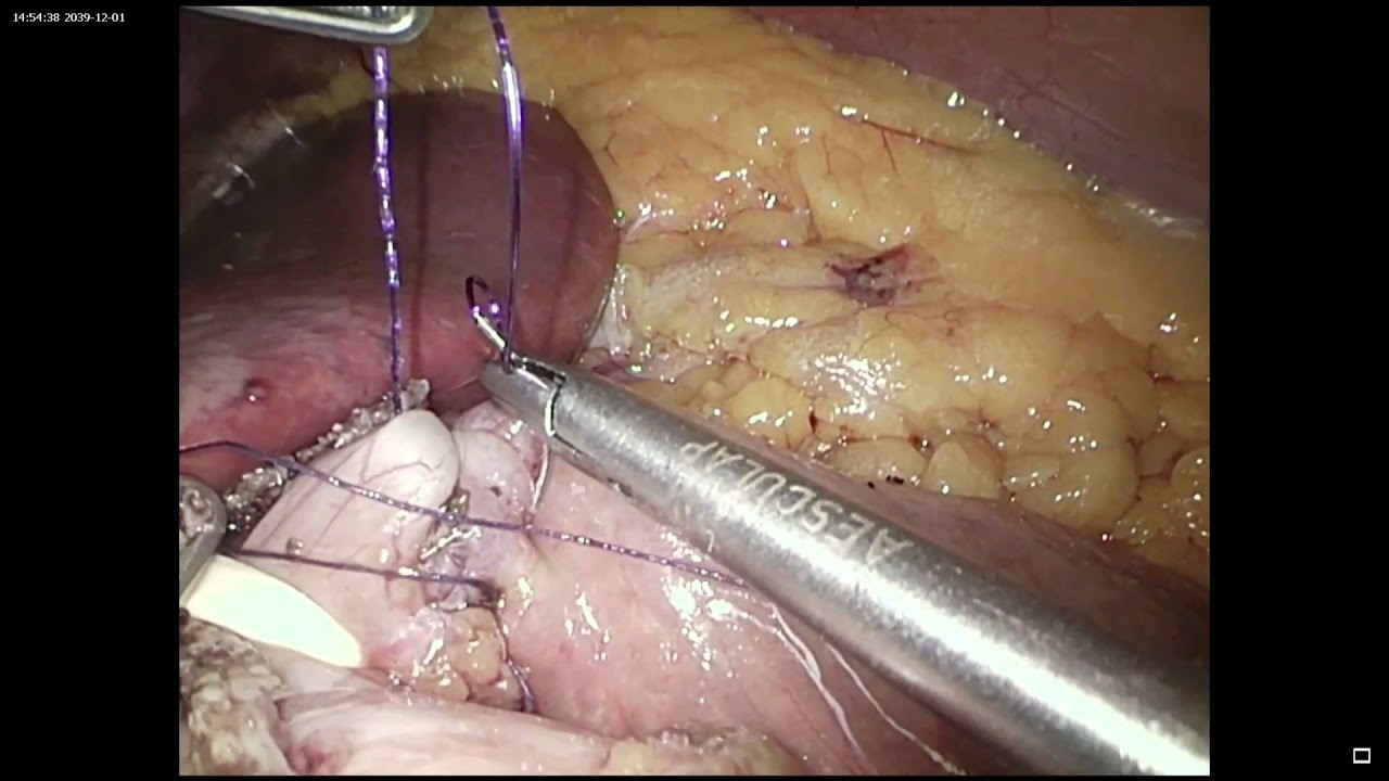 Functional Laparoscopic Roux-en-Y Gastric Bypass (LRYGBfse)