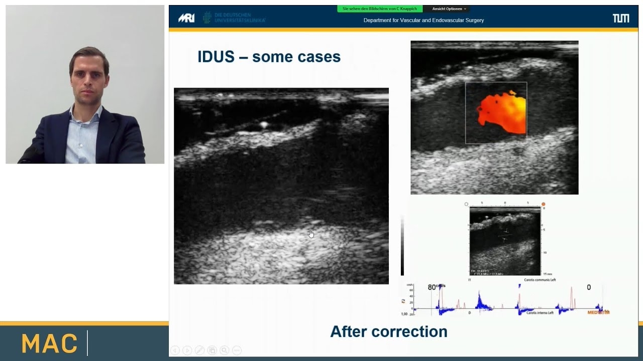 Dr. Christoph Knappich: Online workshop at MAC 2022 “Intraoperative Duplex Ultrasound during CEA