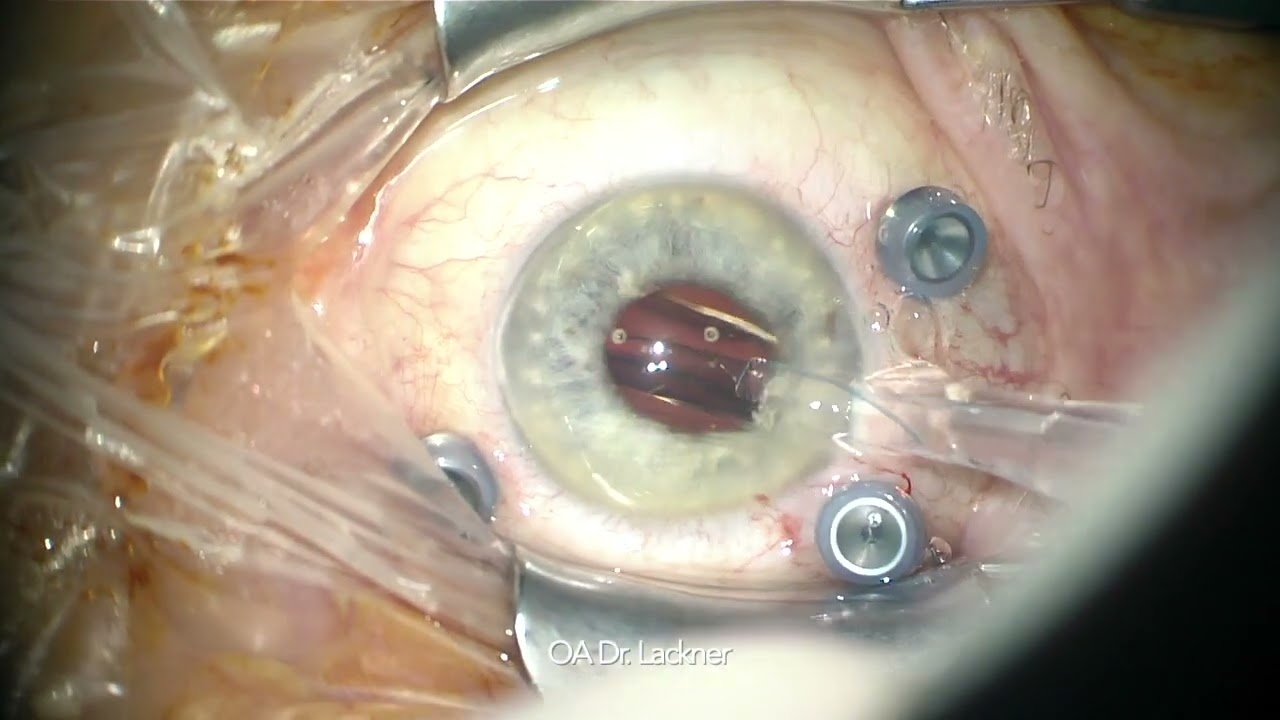 combined phacovitrectomy in rhegmatogenous retinal detachment and dense cataract