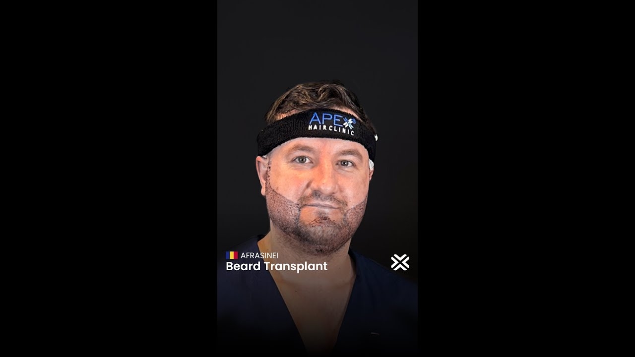 Experiences of our Beard Transplant Patient from Romania