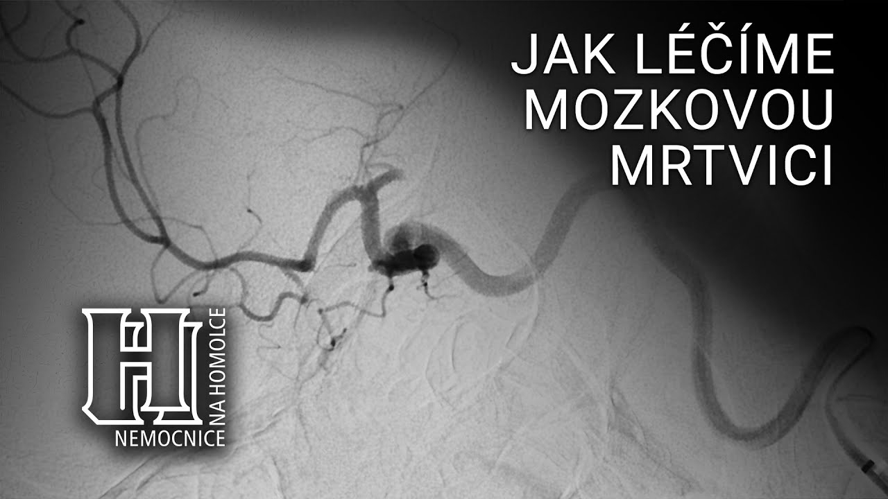 How do we treat a stroke