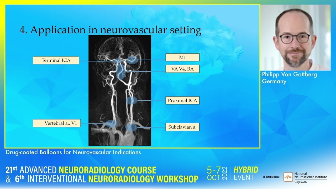 Drug coated Balloons for Neurovascular Indications - Philipp Von Gottberg