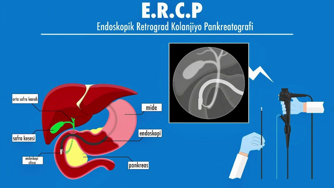 What is ERCP? - Prof. Dr. Alper Yurci (Gastroenterology Uz.)