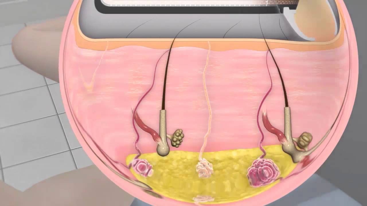 miraDry treatment at youthconnection