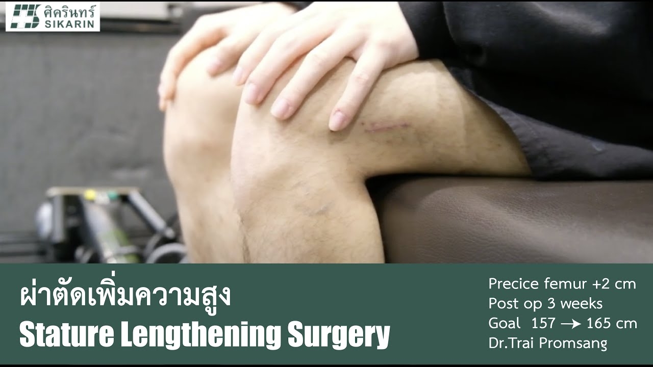 Height Augmentation Surgery | Postoperative Patient Interview | Patient Interview After Stature Lengthening Surgery