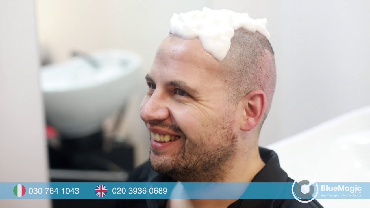 TRAPIANTO DI CAPELLI IN TURCHIA | BlueMagic Group Clinic | BEST HAIR TRANSPLANT TURKEY