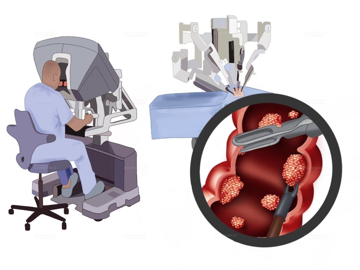 Robotic-Assisted Retroperitoneal Lymph Node Removal in Testicular Tumors | Urological Clinic of TUM University Hospital Rechts der Isar