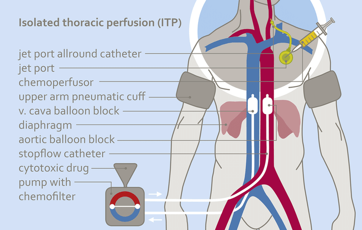 Regional Chemotherapy (RCT) - Isolated Thoracic Perfusion (ITP) | Medias Clinic Burghausen