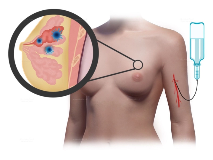 Auger Emitting 161 Tb-PSMA-617 Radioligand Therapy for Prostate Cancer | Saarland University Hospital