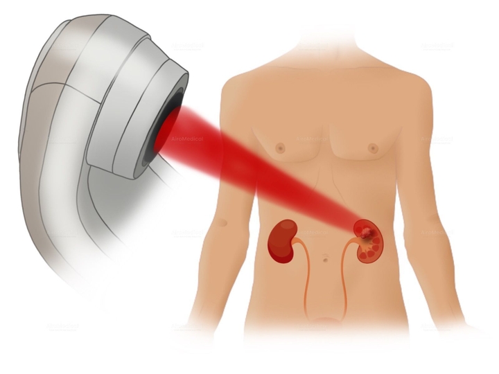 Pediatric Matched Unrelated Donor (MUD) Bone Marrow Transplant Package | University Children's Hospital in Krakow