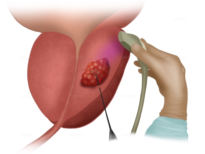 Prostate Embolization for Benign Prostatic Hyperplasia (BPH) - Minimally invasive therapy | Uniclinic Frankfurt, Germany