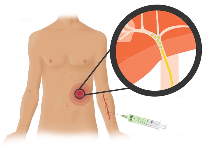 Liver cancer treatment with transarterial chemoperfusion (TACP) | 2 sessions | Uniclinic Frankfurt, Germany