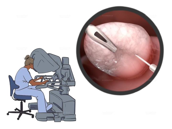 Robotic-Assisted Pyelonephrectomy for Pyeloplasty in Pyelophritis | Urological Clinic of TUM University Hospital Rechts der Isar
