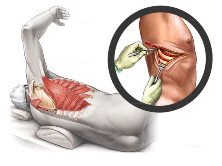 Thoracic Outlet Syndrome Surgery at Memorial Bahçelievler Hospital