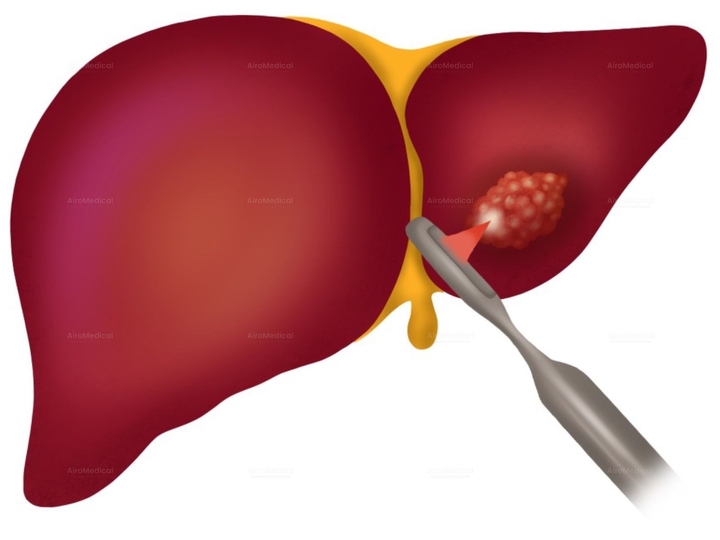 High-Intensity Focused Ultrasound (HIFU) Therapy for Liver Tumors | Uniclinic Frankfurt, Germany