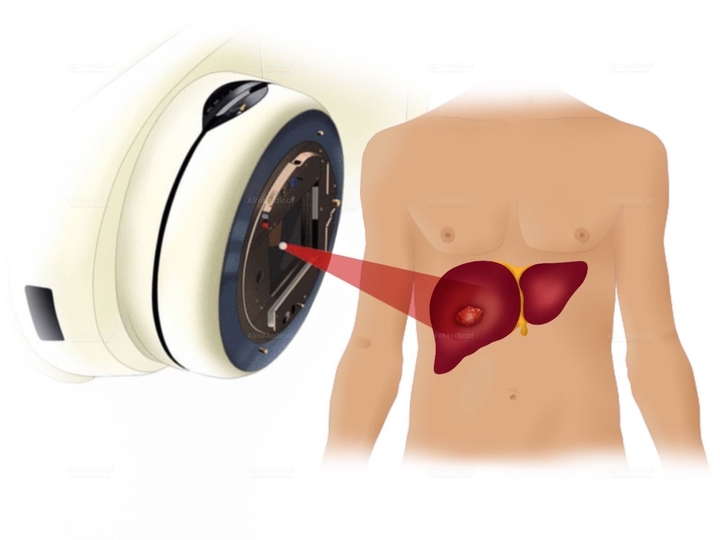 Radiotherapy with Stereotactic Linear Accelerator at Gamma Knife Centre Krefeld