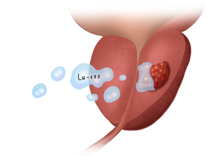 Lutetium-177 PSMA therapy for prostate cancer + Ga-68 PSMA PET scan | 1 cycle - standard package | Helios Clinic Berlin-Buch, Germany