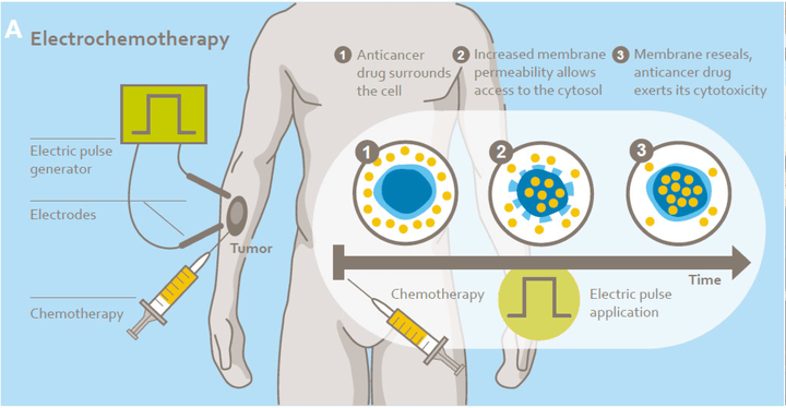 Electrochemotherapy (Reversible Electroporation) for Cancer Treatment at Oncological Clinic Medias in Burghausen, Germany