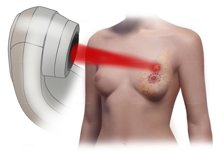177 Lu-PSMA-617 Radioligand Therapy for Prostate Cancer | Saarland University Hospital