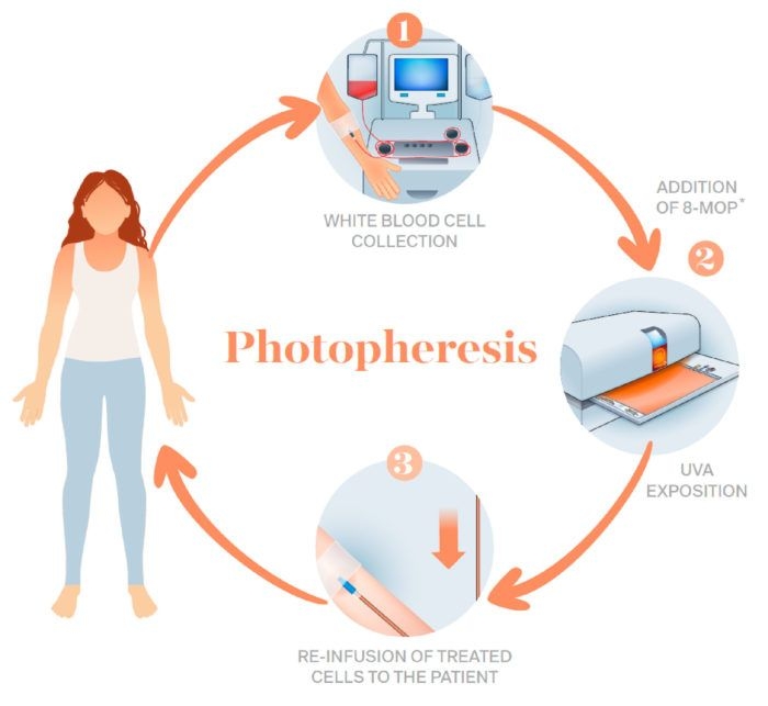 Extracorporeal Photopheresis (ECP) at Centre of Advanced Medicine, Frankfurt, Germany