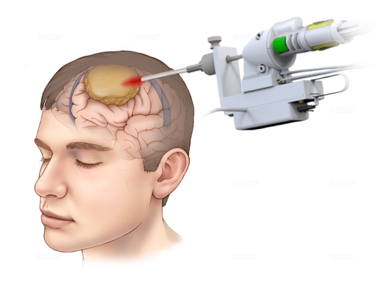 Brain tumor treatment with MRI-guided stereotactic laser ablation