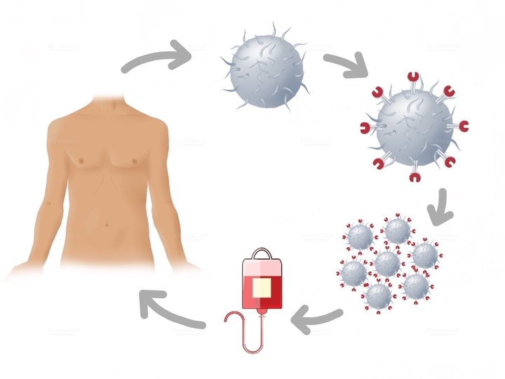 Actinium 225 PSMA Radioligand Therapy for Prostate Cancer | Saarland University Hospital