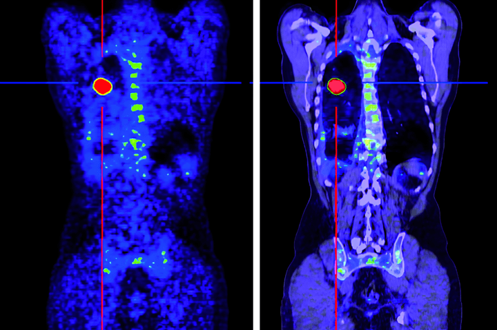 MIBG Therapy | Helios Clinic Berlin-Buch, Germany