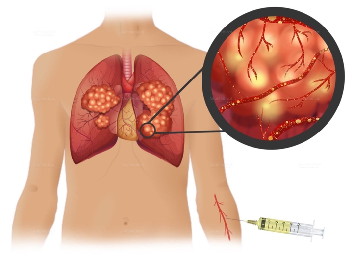 Surgical Mandible Reconstruction Using a Microvascular Graft | University Hospital Rechts der Isar Munich