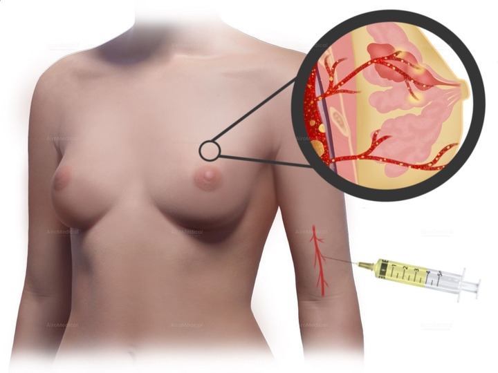 Internal Artery Infusion Chemotherapy for Breast Cancer at Medias Clinic Burghausen