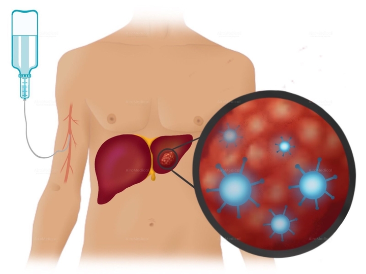 NanoKnife (Erreversible Electroporation - IRE) for Liver Tumor | University Clinic Rechts der Isar