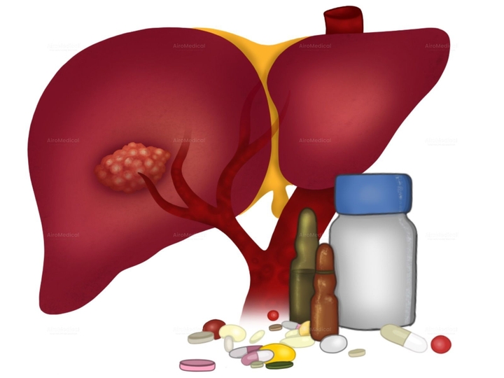 Carotid Artery Infusion with Chemofiltration for Head & Neck Cancer | Medias Clinic Burghausen