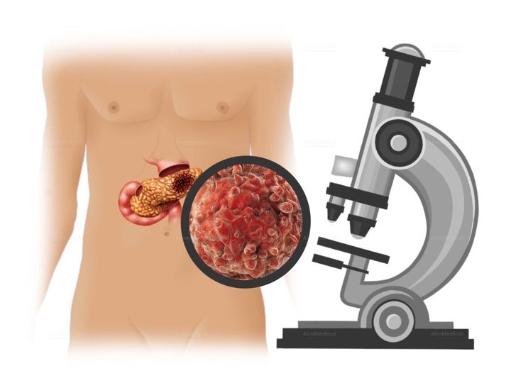 NanoKnife (Erreversible Electroporation - IRE) for Pancreatic Tumor | University Clinic Rechts der Isar