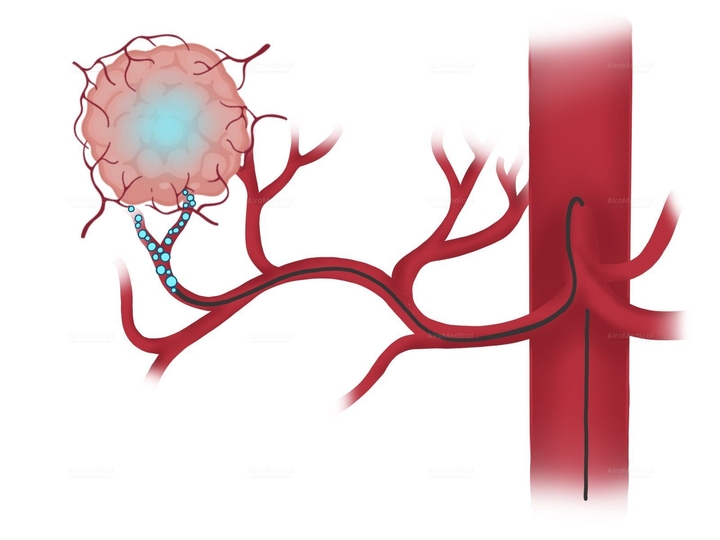 Selective Internal Radioembolization with SIR-Spheres (SIRT) for Liver Tumors/Metastases | Uniclinic Frankfurt, Germany