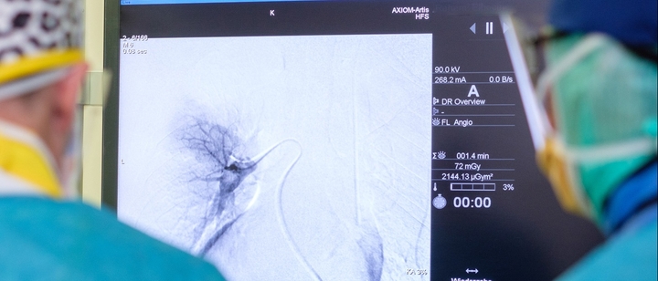 Transpulmonary chemoembolization (TPCE) - Minimally invasive treatment of lung tumors | 2 sessions | Uniclinic Frankfurt, Germany