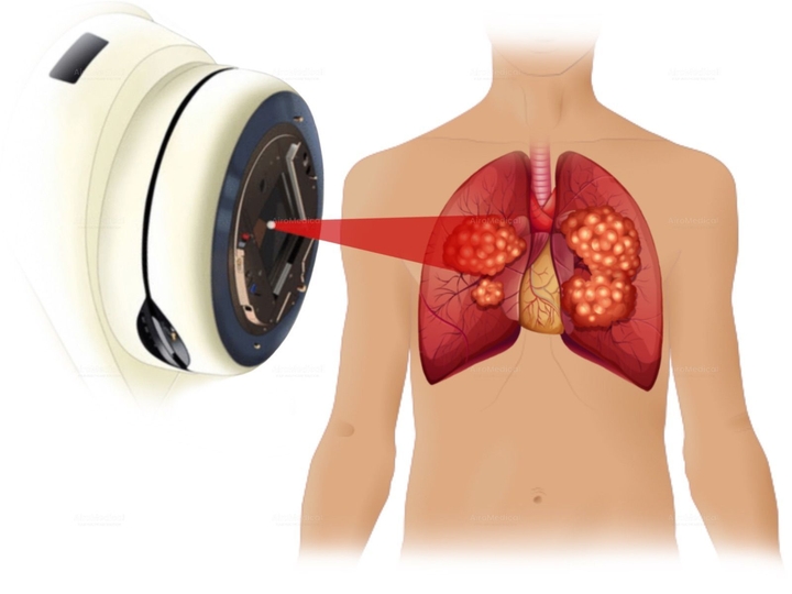 Brain Metastasis Removal Surgery at Neurosurgical Clinic of University Hospital Rechts der Isar Munich