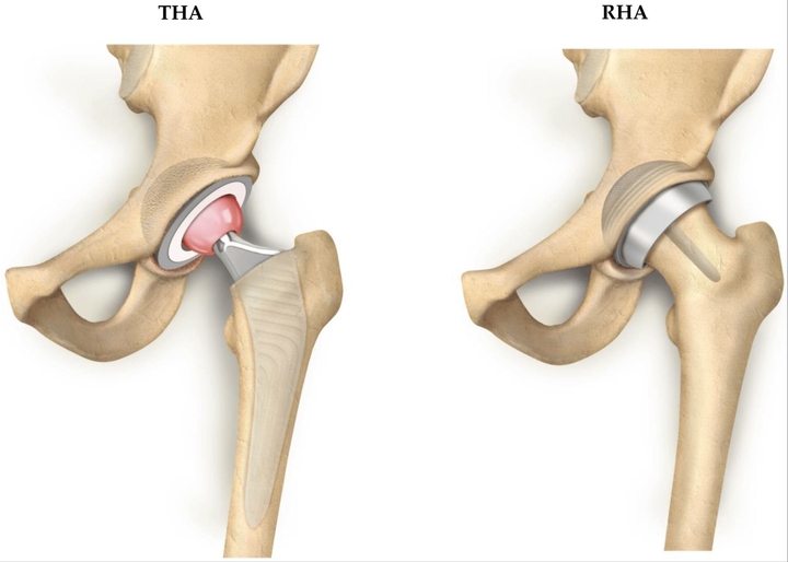Minimally-Invasive Hip Replacement/Resurfacing | Package at Teknon Medical Centre