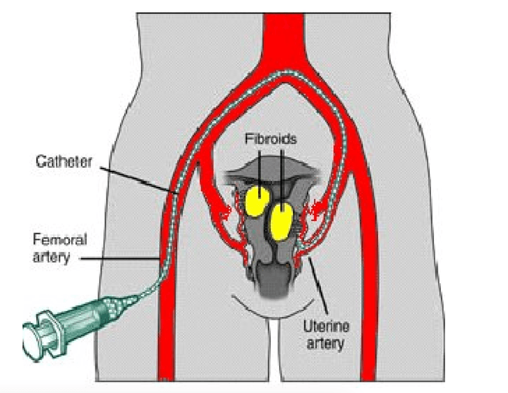 Uterine fibroid (myoma) embolization - Minimally invasive therapy | Uniclinic Frankfurt, Germany