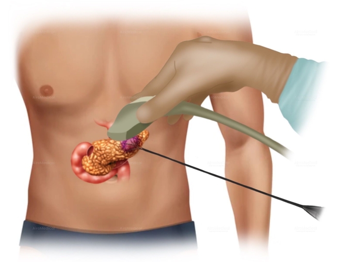 Sonalleve MR-HIFU - High-Intensity Focused Ultrasound Pancreatic Tumor Ablation | Pancreatic Cancer Center CIO Cologne