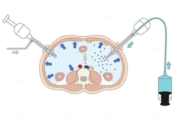 Pressurized Intraperitoneal Aerosol Chemotherapy (PIPAC) | Teknon Peritoneal Cancer Institute, Spain