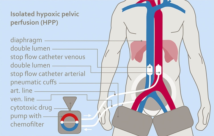 Regional Chemotherapy (RCT) - Isolated Hypoxic Pelvic Perfusion (HPP) | Medias Clinic Burghausen