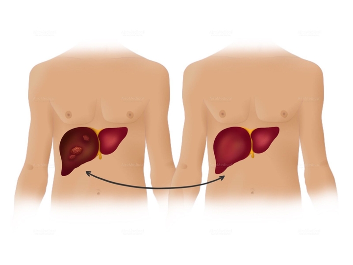 Chemoembolization for Liver Tumor at Medias Clinic Burghausen