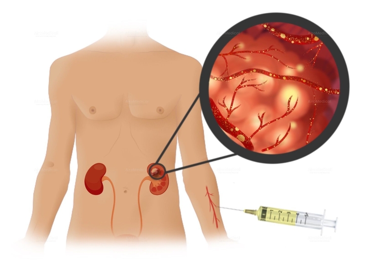 TOOKAD Vascular Targeted Photodynamic Therapy for Prostate Cancer at Vivantes Clinic Am Urban