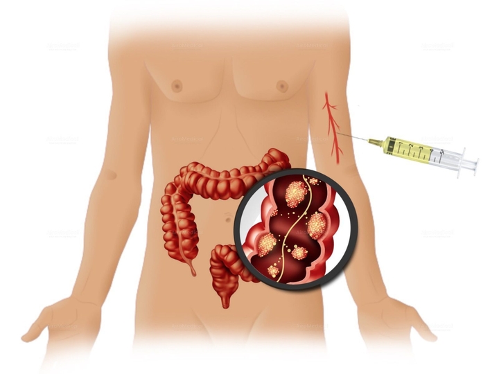 Intra-Arterial Celiac Axis Infusion Chemotherapy for Pancreatic Cancer at Medias Clinic Burghausen