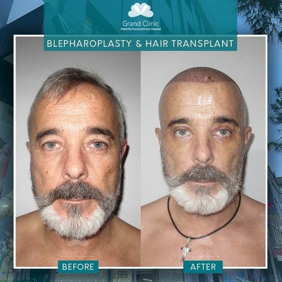 Upper Blepharoplasty (Under Local Anesthesia) Grand Clinic Istanbul