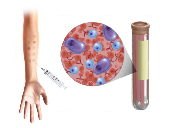 Electrochemotherapy (Reversible Electroporation) for Cancer Treatment at Oncological Clinic Medias in Burghausen, Germany