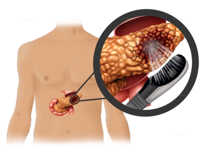 High-Intensity Focused Ultrasound (HIFU) Therapy for Pancreatic Tumors | Uniclinic Frankfurt, Germany